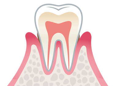軽度の歯周病