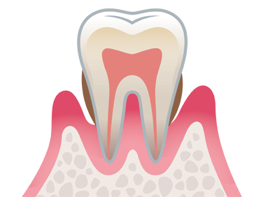 中度の歯周病