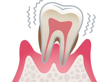 重度の歯周病